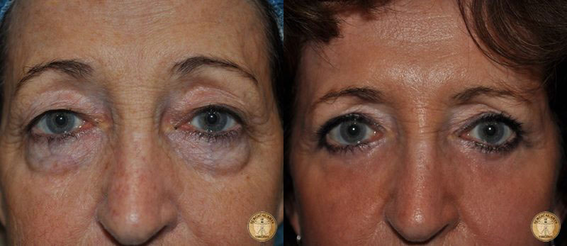 surgical reduction of the eyelids